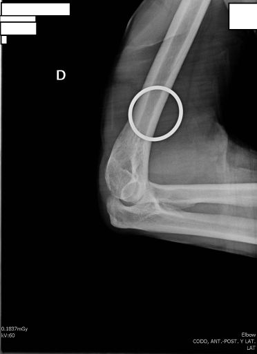 Diagrama Lateral Codo